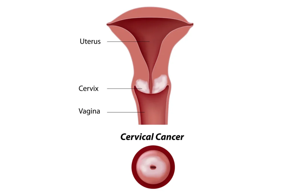 Cervical cancer medical diagram by Krishna Cancer Hospital Bhopal