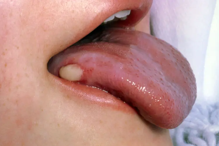 Oral cancer sore on tongue by Krishna Cancer Hospital Bhopal