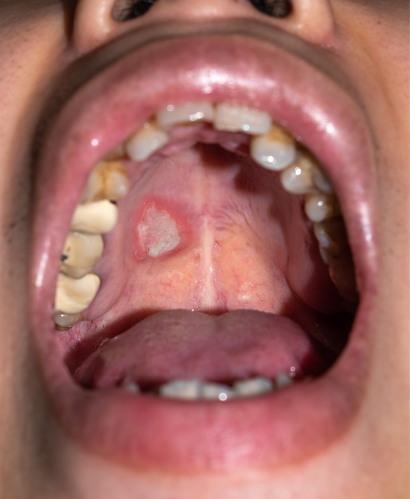 Hard palate cancer sore inside mouth by Krishna Cancer Hospital Bhopal