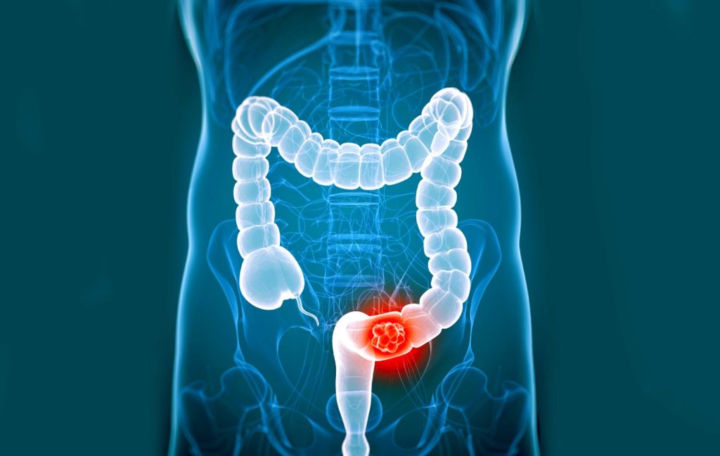Colorectal cancer tumor highlighted in the colon showing colorectal cancer treatment at Krishna Cancer Hospital Bhopal.