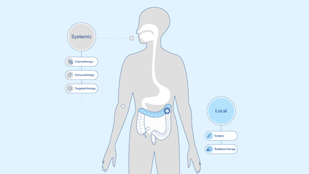 Colorectal cancer treatment infographic showing surgery, radiation therapy, chemotherapy, immunotherapy and targeted therapy at Krishna Cancer Hospital Bhopal.