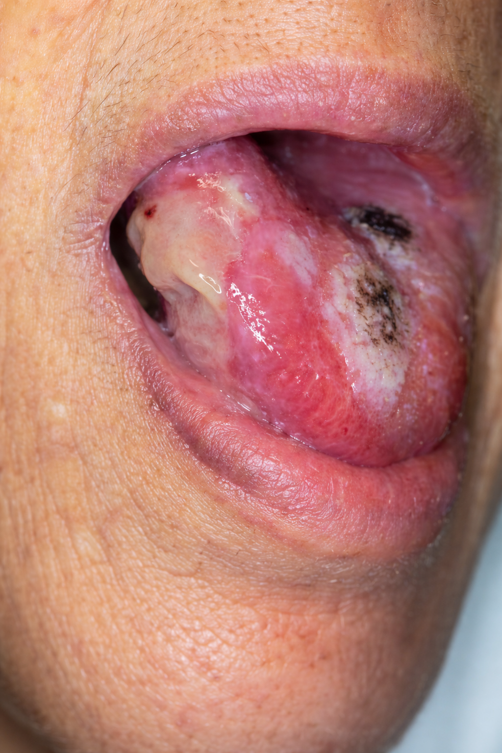 Gum cancer lesion inside mouth treated at Krishna Cancer Hospital Bhopal