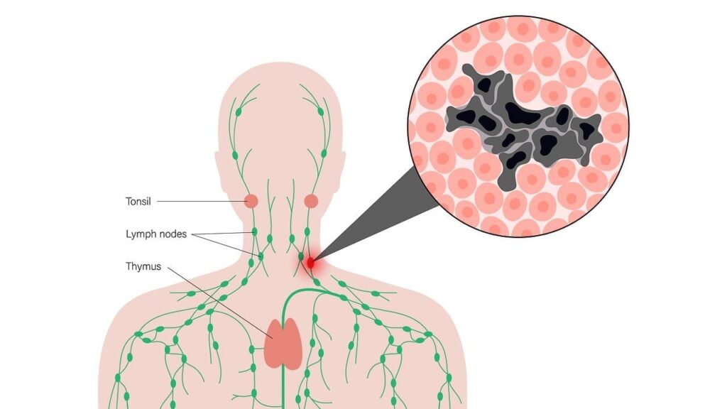 Lymphoma cancer affecting lymph nodes diagram by Krishna Cancer Hospital Bhopal