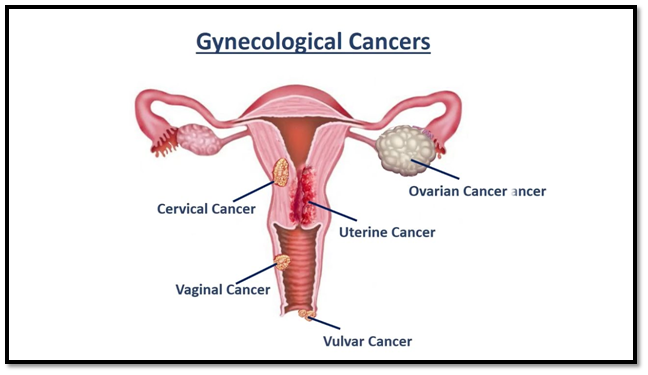 Gynecological cancers diagram by Krishna Cancer Hospital Bhopal