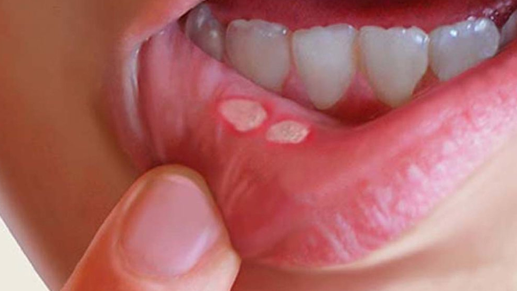 Lip cancer sores or white patches on inner lip examined at Krishna Cancer Hospital Bhopal
