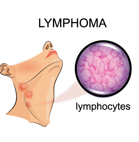 Lymphoma cancer illustration showing swollen lymph nodes by Krishna Cancer Hospital Bhopal