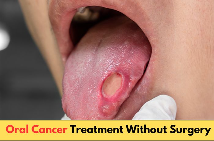 Oral cancer sore on tongue by Krishna Cancer Hospital Bhopal