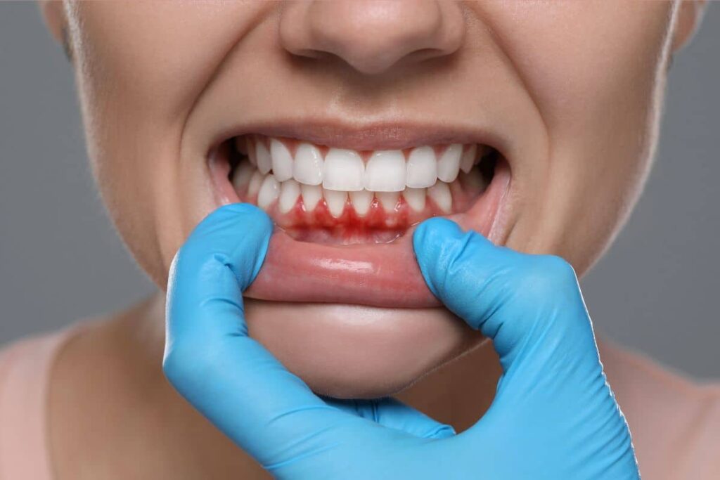 Early signs of gum cancer with red inflamed gums examined at Krishna Cancer Hospital Bhopal