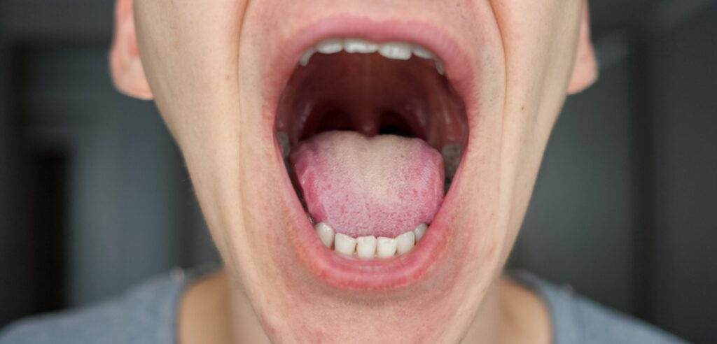 Inner cheek cancer symptoms inside mouth examined at Krishna Cancer Hospital Bhopal
