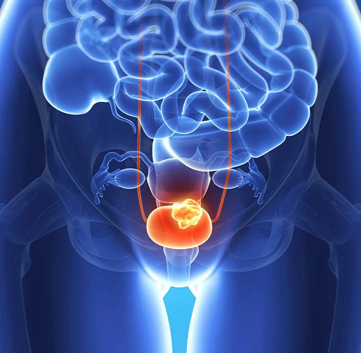 Bladder cancer tumor shown in the urinary bladder illustration for bladder cancer treatment at Krishna Cancer Hospital Bhopal.