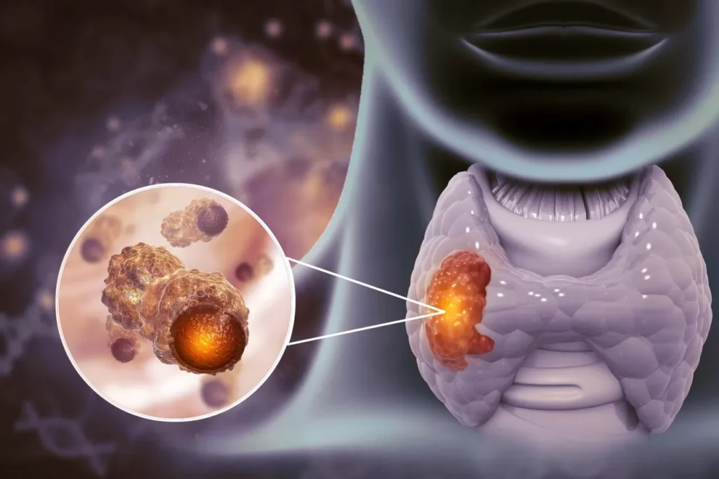 Medical illustration of thyroid cancer tumor in the thyroid gland in the neck.