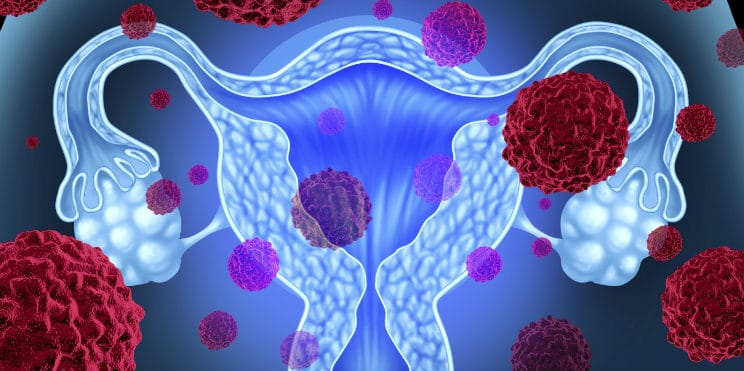 Uterine cancer cells illustration in female reproductive system at Krishna Cancer Hospital Bhopal