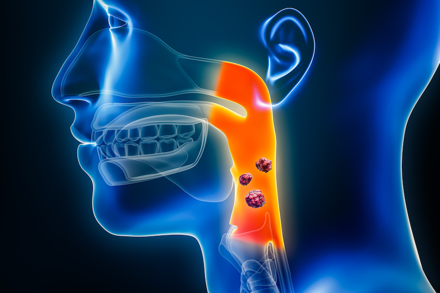 Head and neck cancer tumor illustration in throat by Krishna Cancer Hospital Bhopal