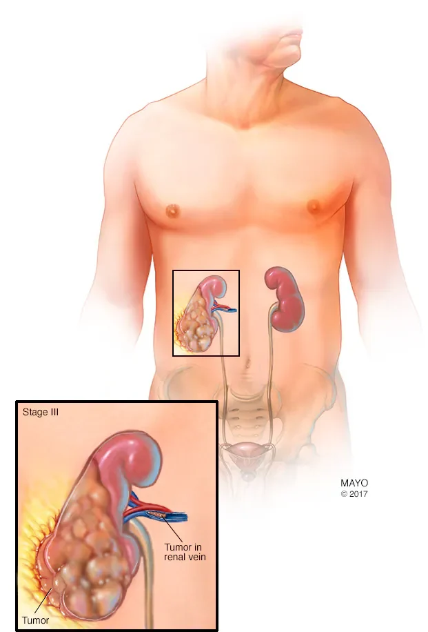 Kidney cancer tumor shown in kidney and renal vein illustration at Krishna Cancer Hospital Bhopal.