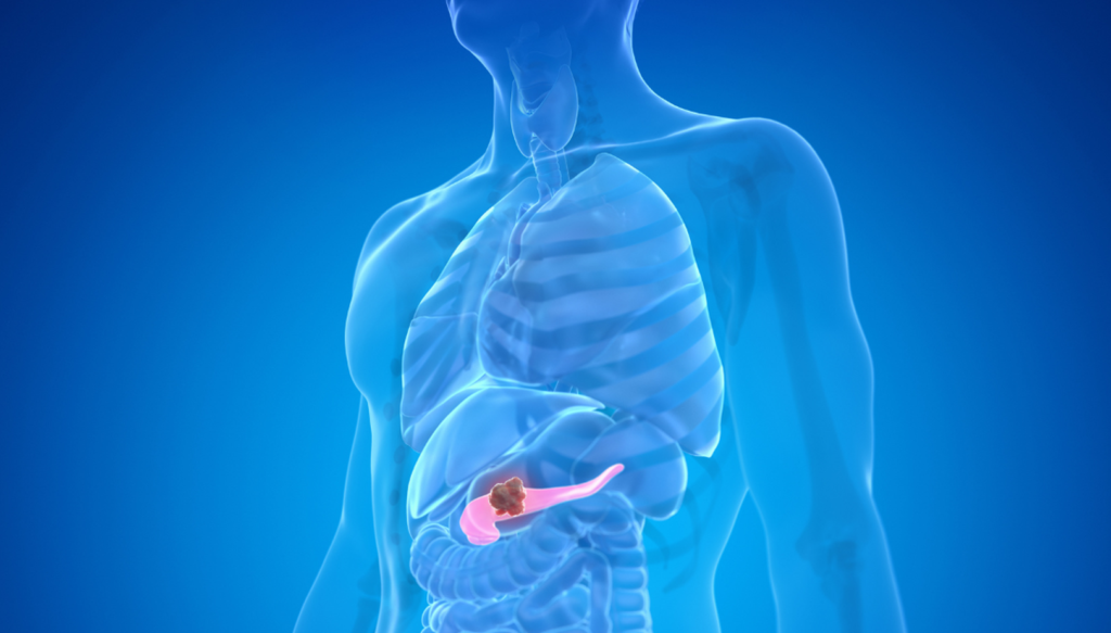 Pancreatic cancer tumor shown in pancreas in human digestive system illustration at Krishna Cancer Hospital Bhopal.
