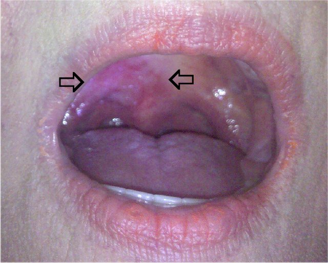 Hard palate cancer symptoms inside mouth by Krishna Cancer Hospital Bhopal