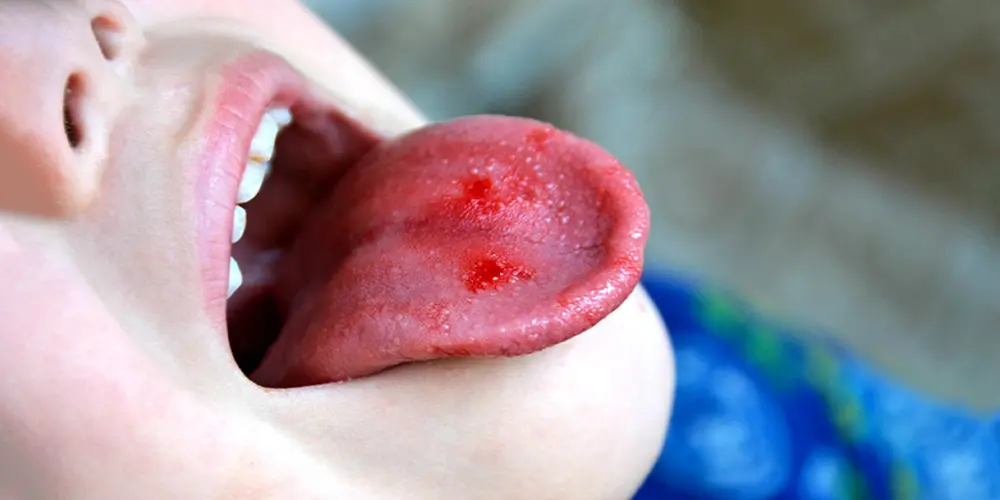 Tongue cancer sore or lesion on tongue examined at Krishna Cancer Hospital Bhopal