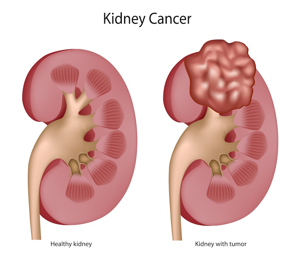 Kidney cancer comparison showing healthy kidney and kidney with tumor at Krishna Cancer Hospital Bhopal.